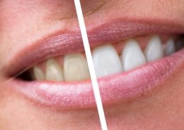 Teeth whitening in Henderson